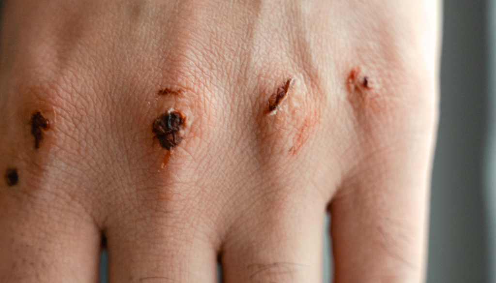 Jednym z czynników wpływających na czas gojenia się rany jest rodzaj stosowanego opatrunku (Źródło: canva.com)