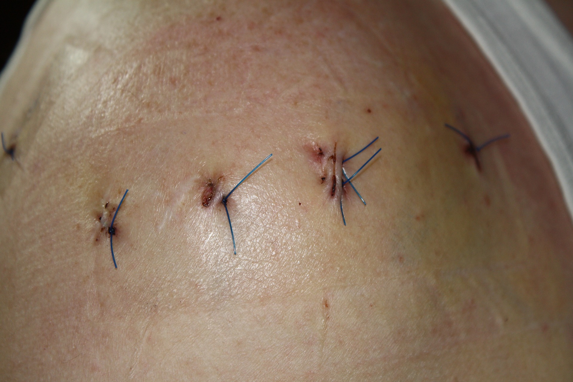 Podstawowe techniki szycia chirurgicznego dzieli się na szwy pojedyncze i ciągłe. (źródło: pixabay.com, autor: Ulrike Mai)
